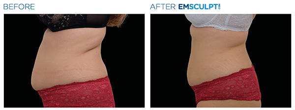 Emsculpt_neo_PIC_Ba-card-female-abdomen-025_ENUS100