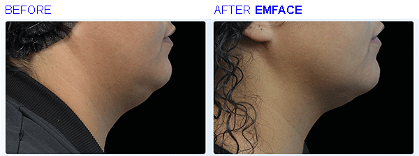 emface10