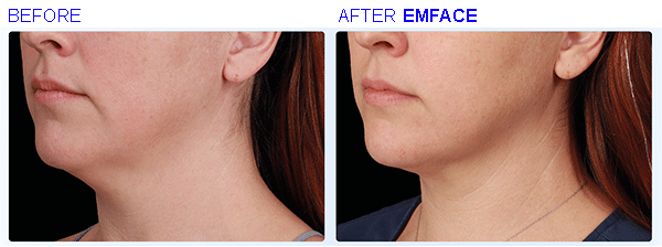 emface11