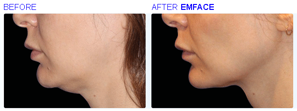 emface13