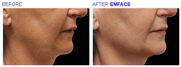 emface2