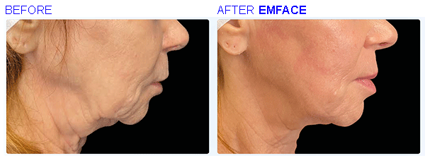 emface3