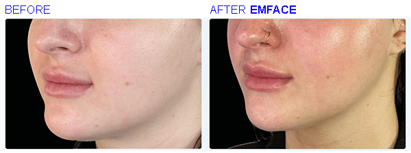 emface4