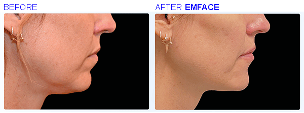 emface5