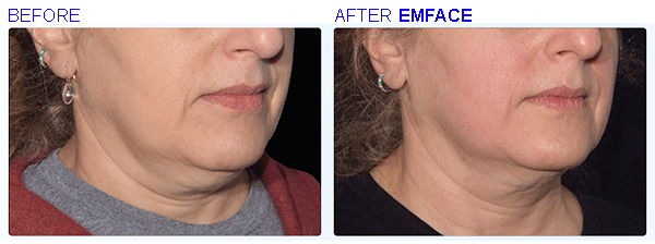 emface7