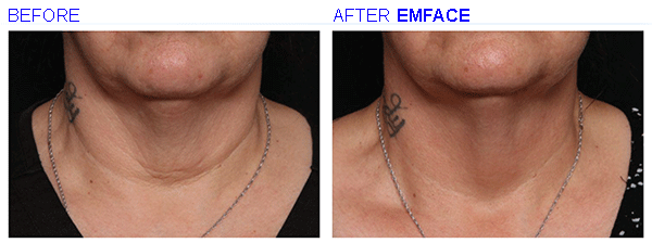 emface8